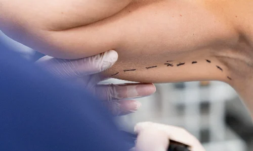 Arm & Flank Liposuction | Plastic Surgery Indian