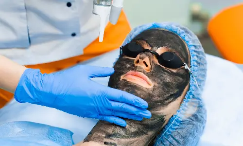 Carbon Photo Facial