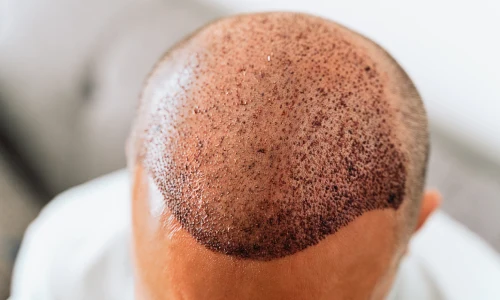 FUT Hair Transplant | Plastic Surgery Indian 