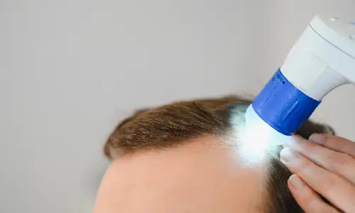Laser Hair Rejuvenation