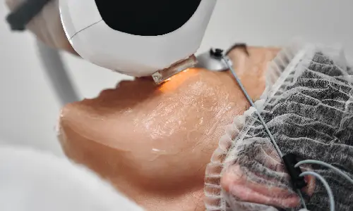 Laser Skin Resurfacing