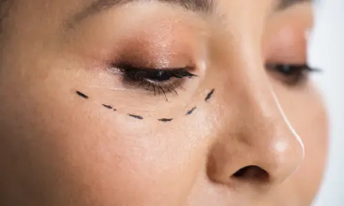 Lower Eyelid Surgery | Plastic Surgery Indian