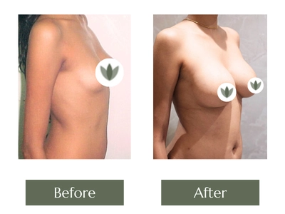 Breast Enlargement