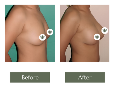 Breast Enlargement