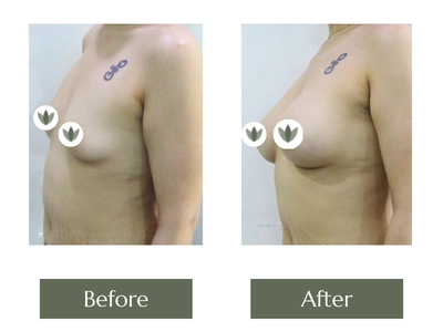Breast Enlargements