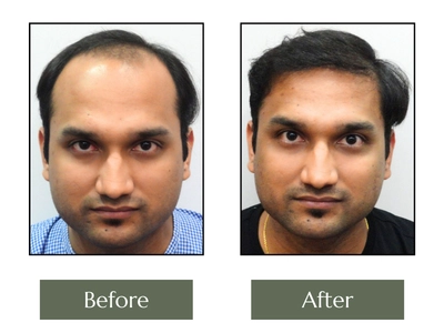 Hair-Transplant