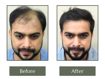 Hair-Transplant