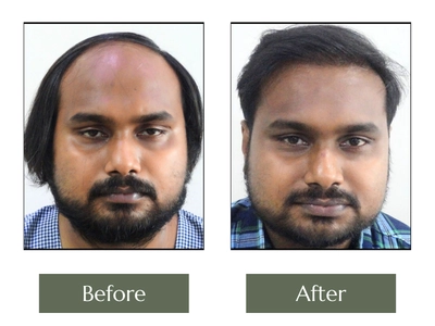 Hair-Transplant