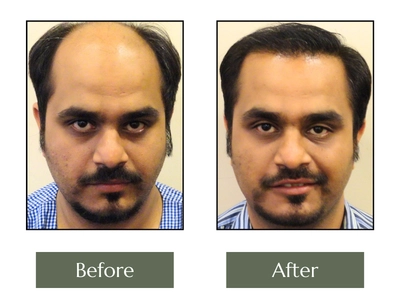 Hair-Transplant