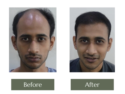 Hair-Transplant