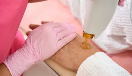 Laser Vein Treatment